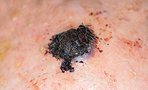 Melanoma Specialist NYC